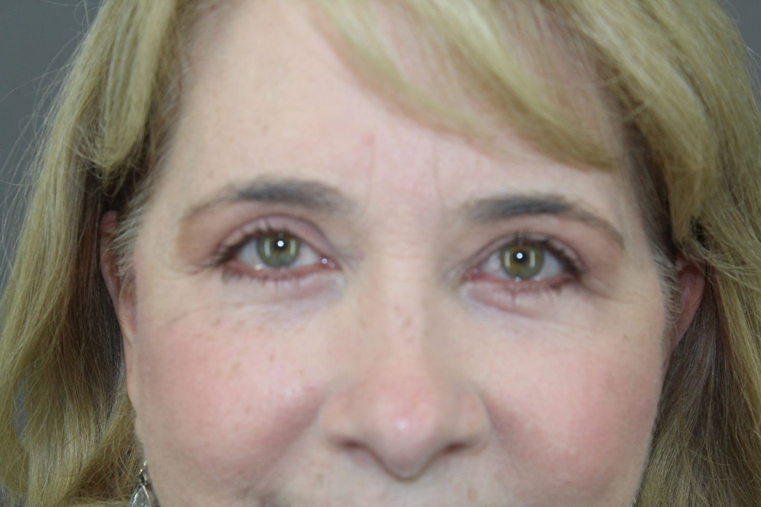 Eyelid Surgery Before & After