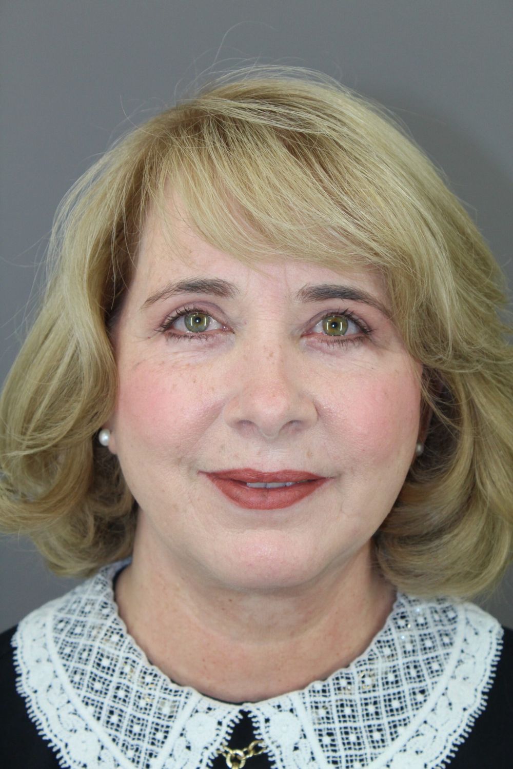 Eyelid Surgery Before & After