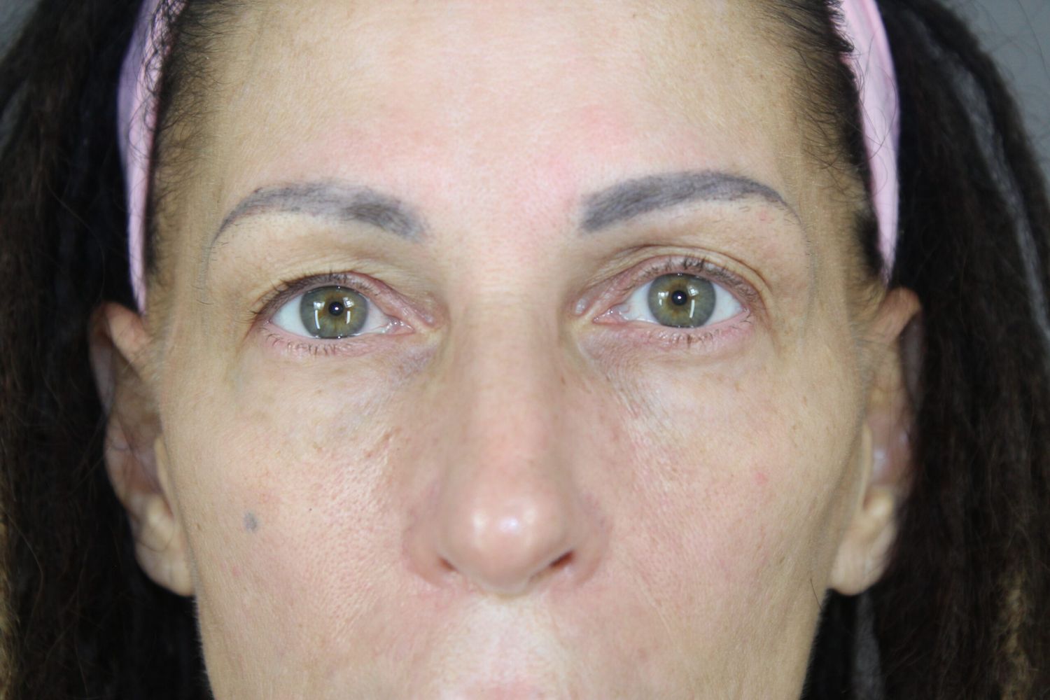 Eyelid Surgery Before & After