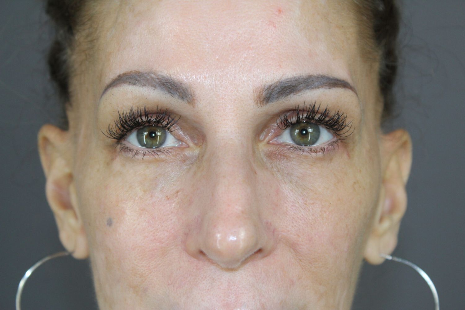 Eyelid Surgery Before & After