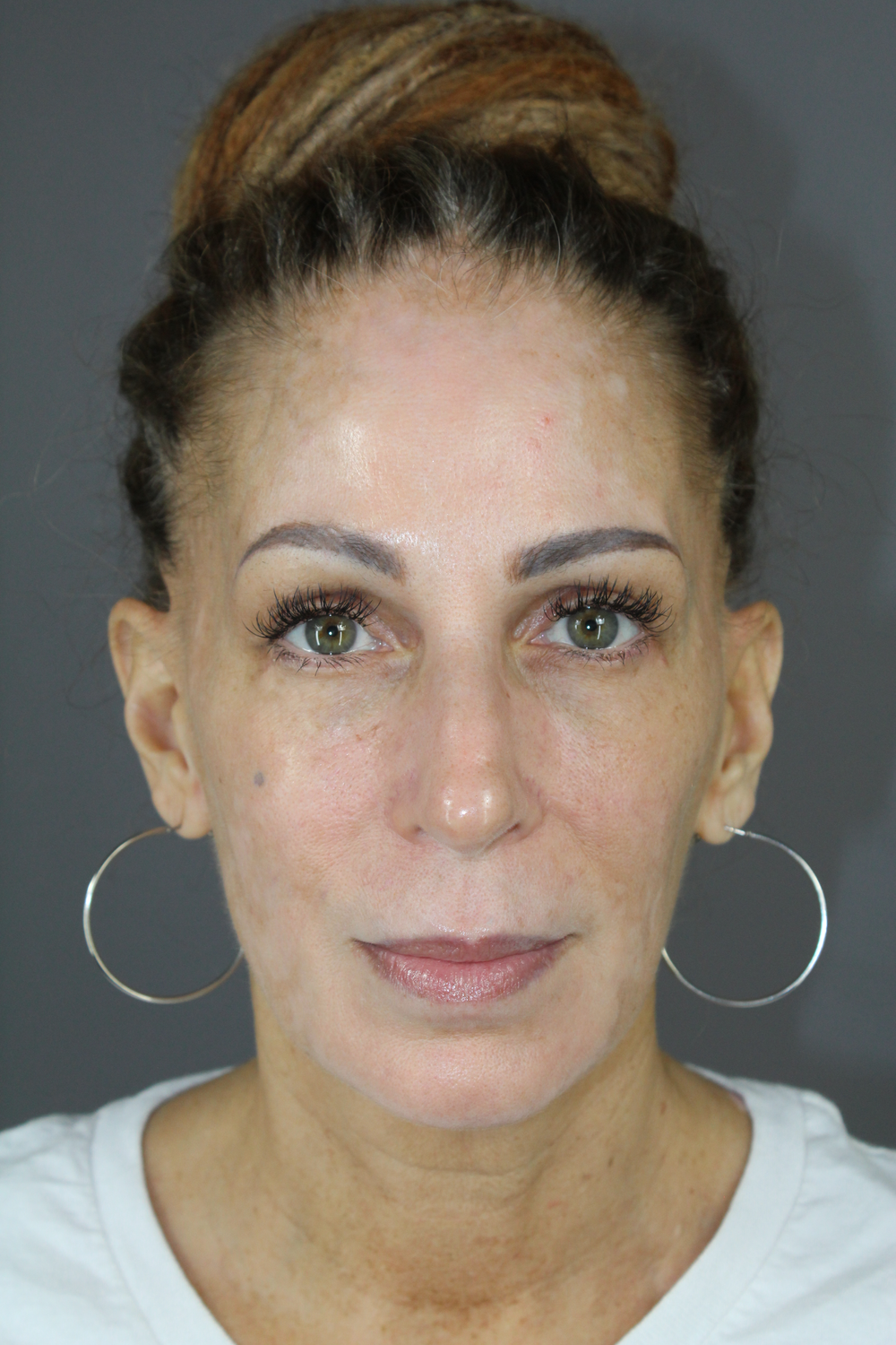 Eyelid Surgery Before & After