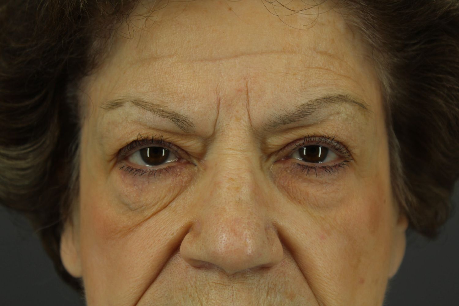 Eyelid Surgery Before & After