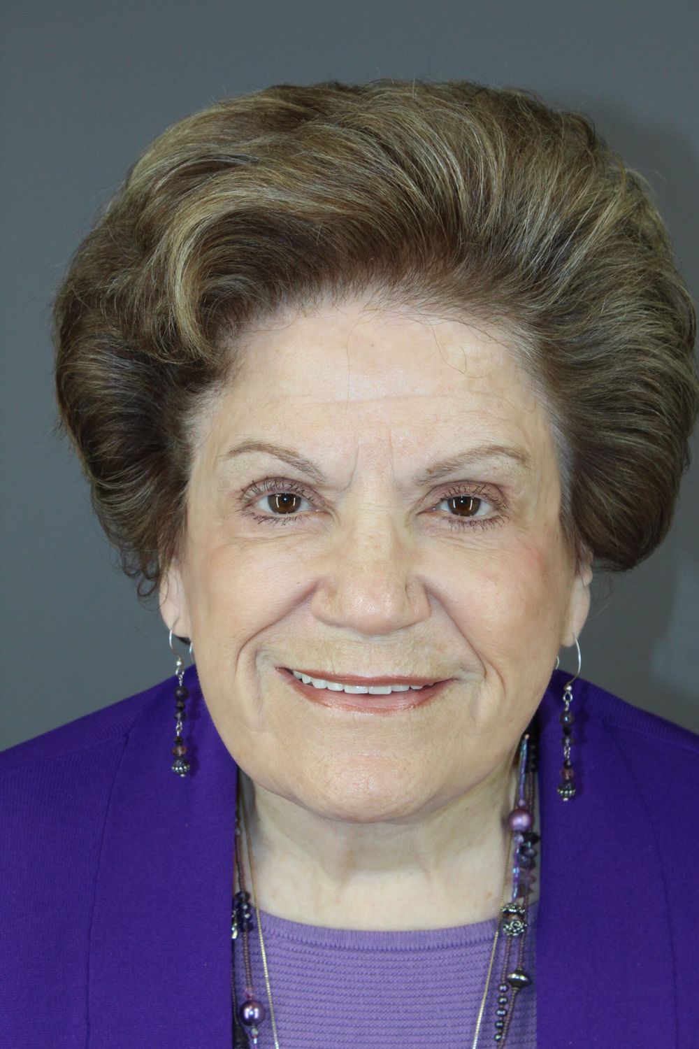 Eyelid Surgery Before & After