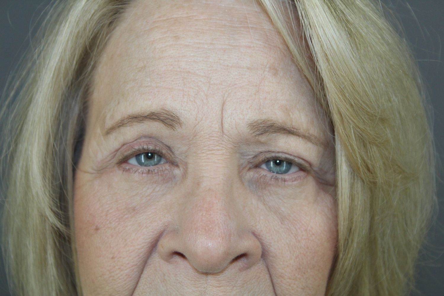 Eyelid Surgery Before & After