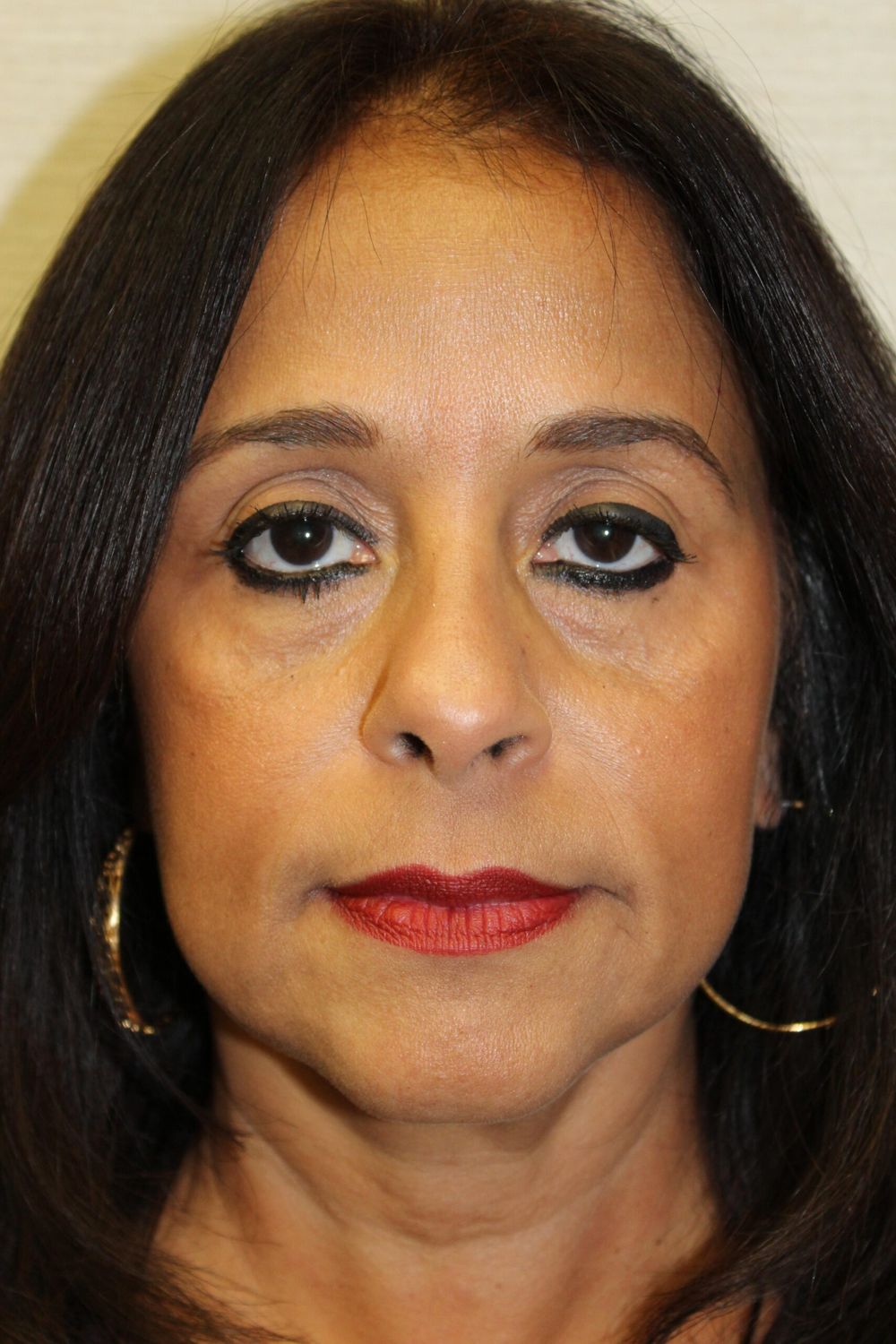 Eyelid Surgery Before & After