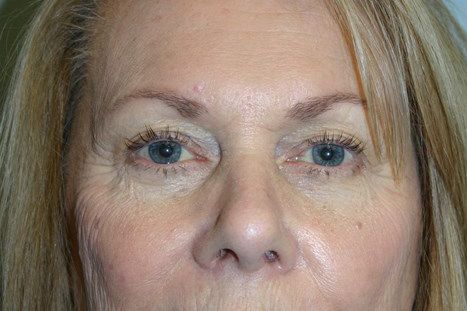Eyelid Surgery Before & After