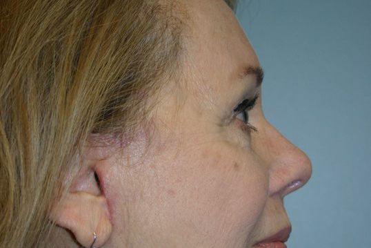 Eyelid Surgery Before & After