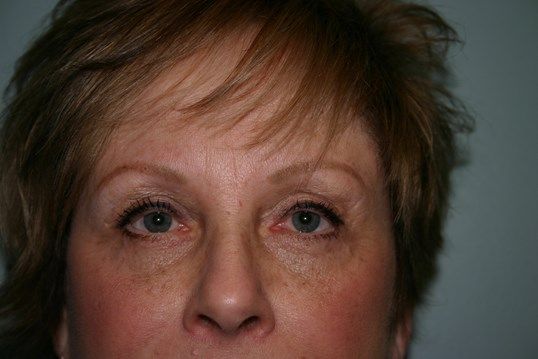 Eyelid Surgery Before & After