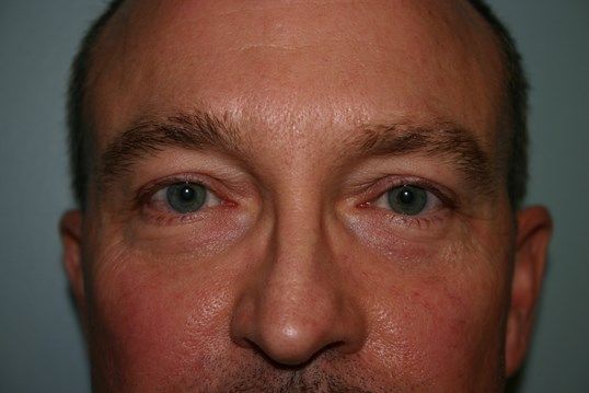 Eyelid Surgery Before & After