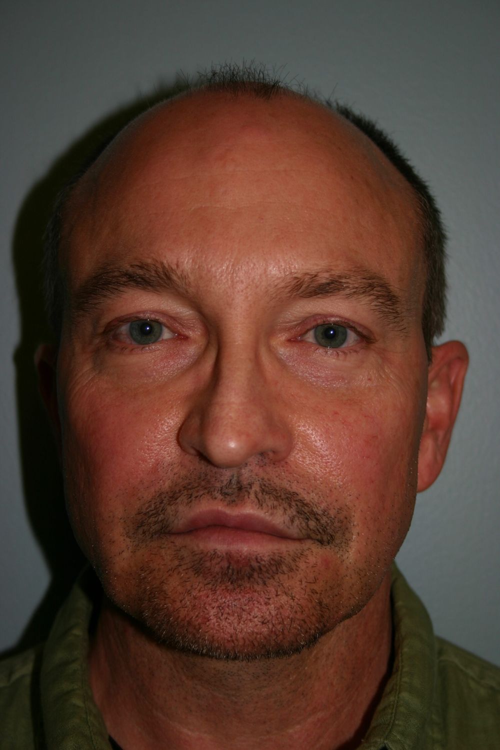 Eyelid Surgery Before & After