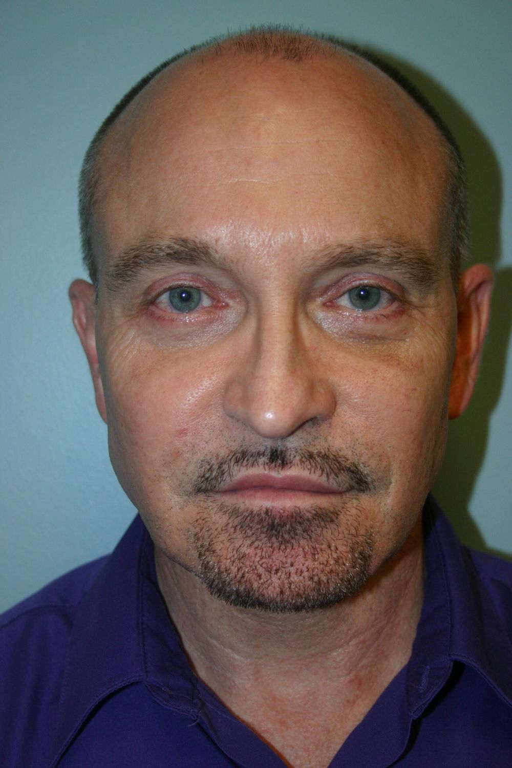 Eyelid Surgery Before & After