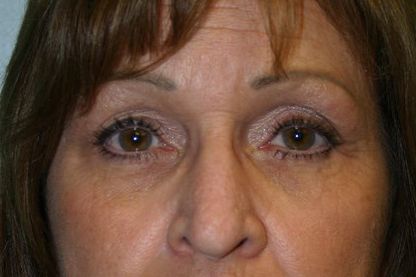 Eyelid Surgery Before & After