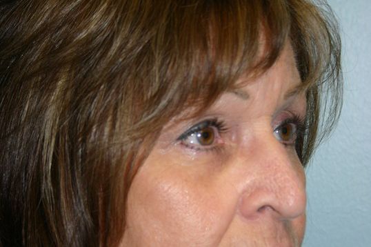 Eyelid Surgery Before & After