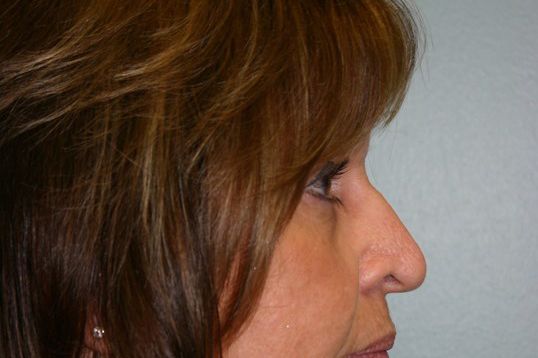 Eyelid Surgery Before & After