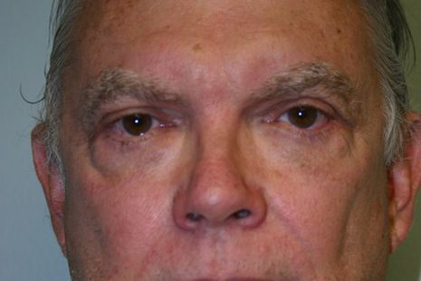 Eyelid Surgery Before & After