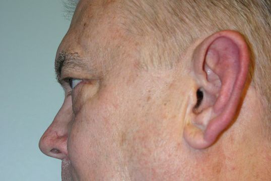 Eyelid Surgery Before & After