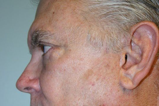 Eyelid Surgery Before & After