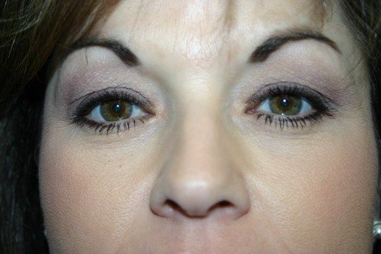 Eyelid Surgery Before & After