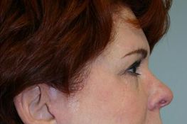 Eyelid Surgery Before & After