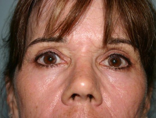 Eyelid Surgery Before & After