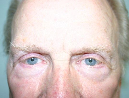 Eyelid Surgery Before & After