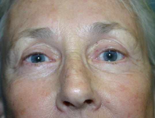 Eyelid Surgery Before & After