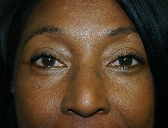 Eyelid Surgery Before & After