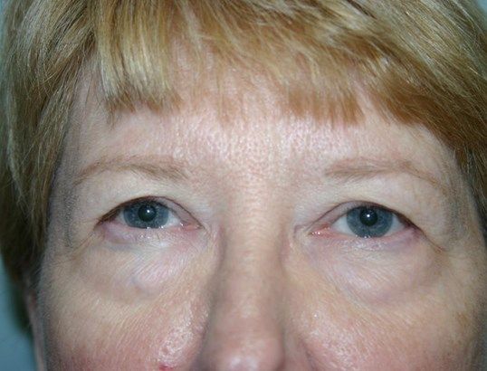 Eyelid Surgery Before & After