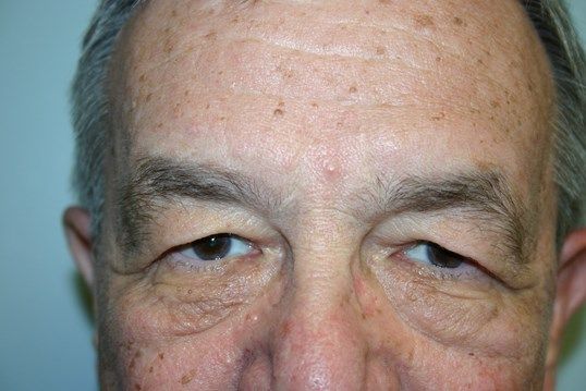 Eyelid Surgery Before & After