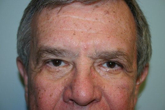 Eyelid Surgery Before & After