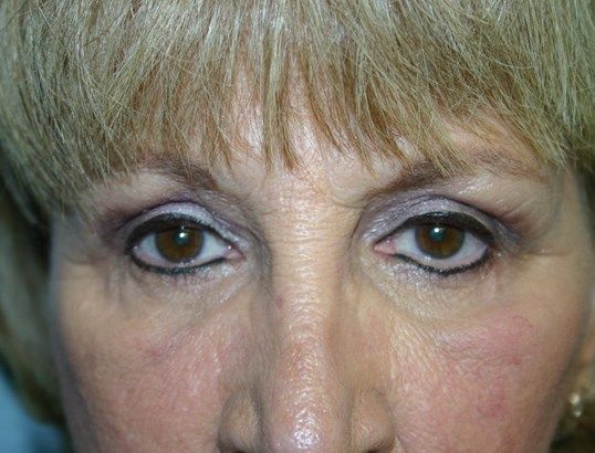 Eyelid Surgery Before & After