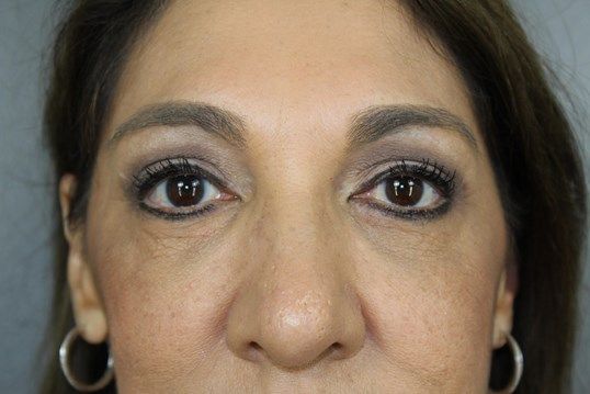 Eyelid Surgery Before & After