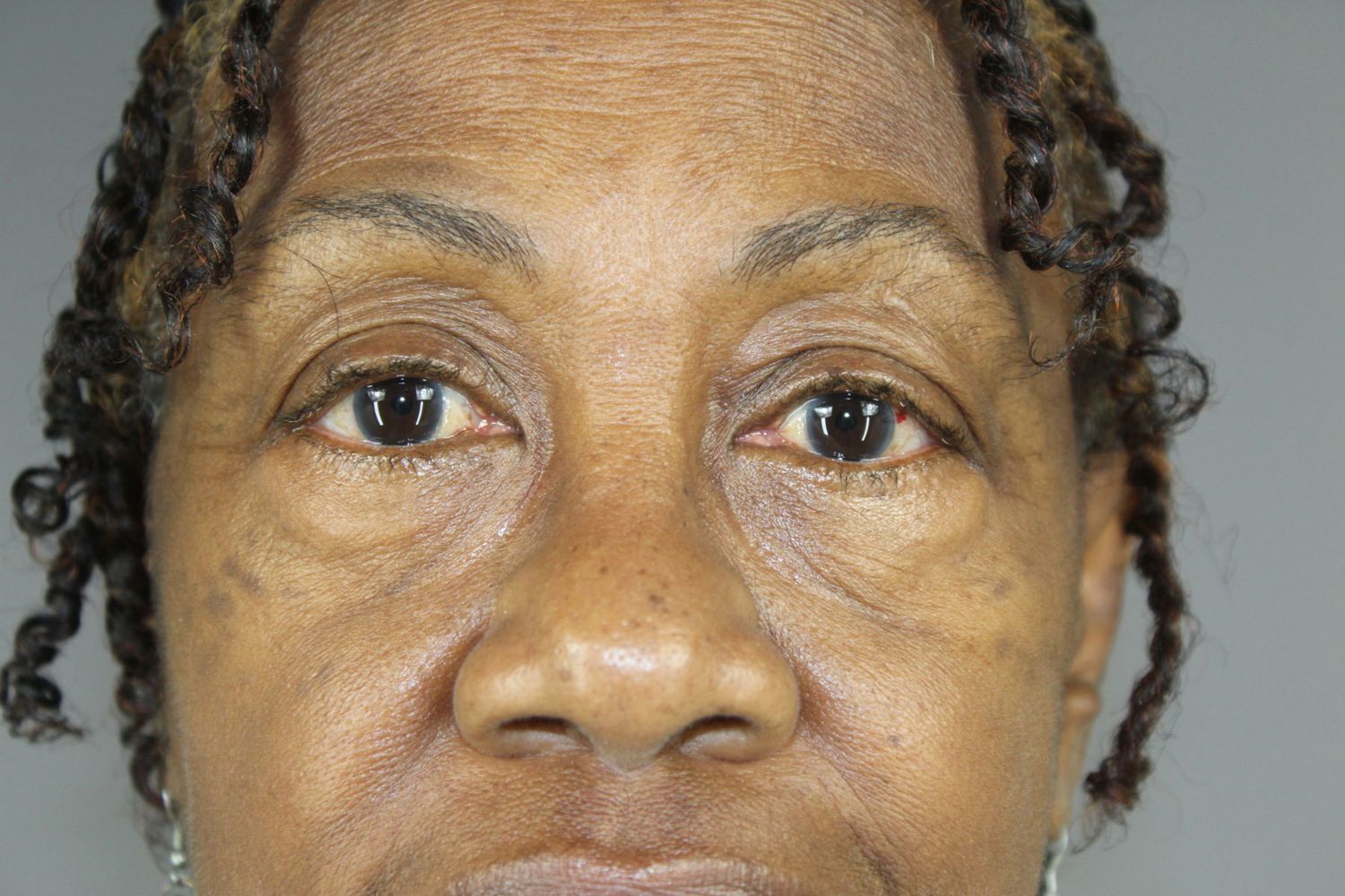 Eyelid Surgery Before & After