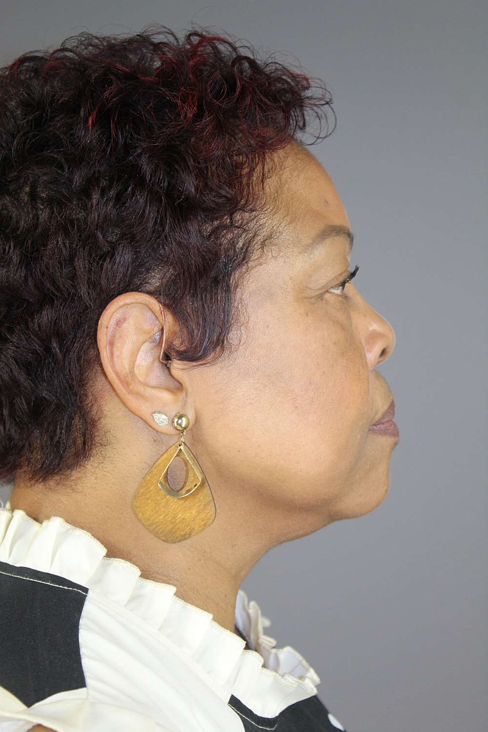 Eyelid Surgery Before & After