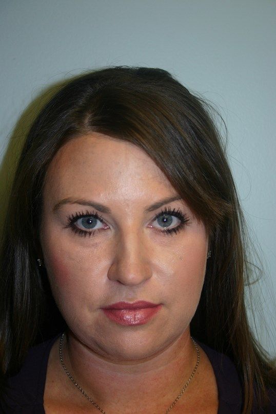 Kybella Before & After