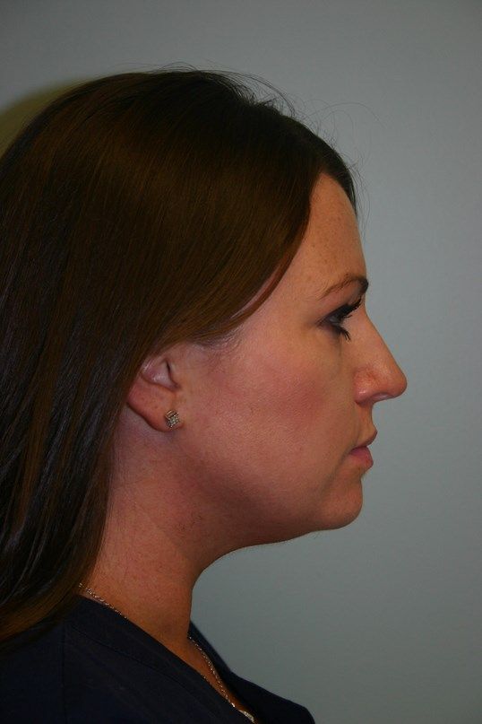 Kybella Before & After