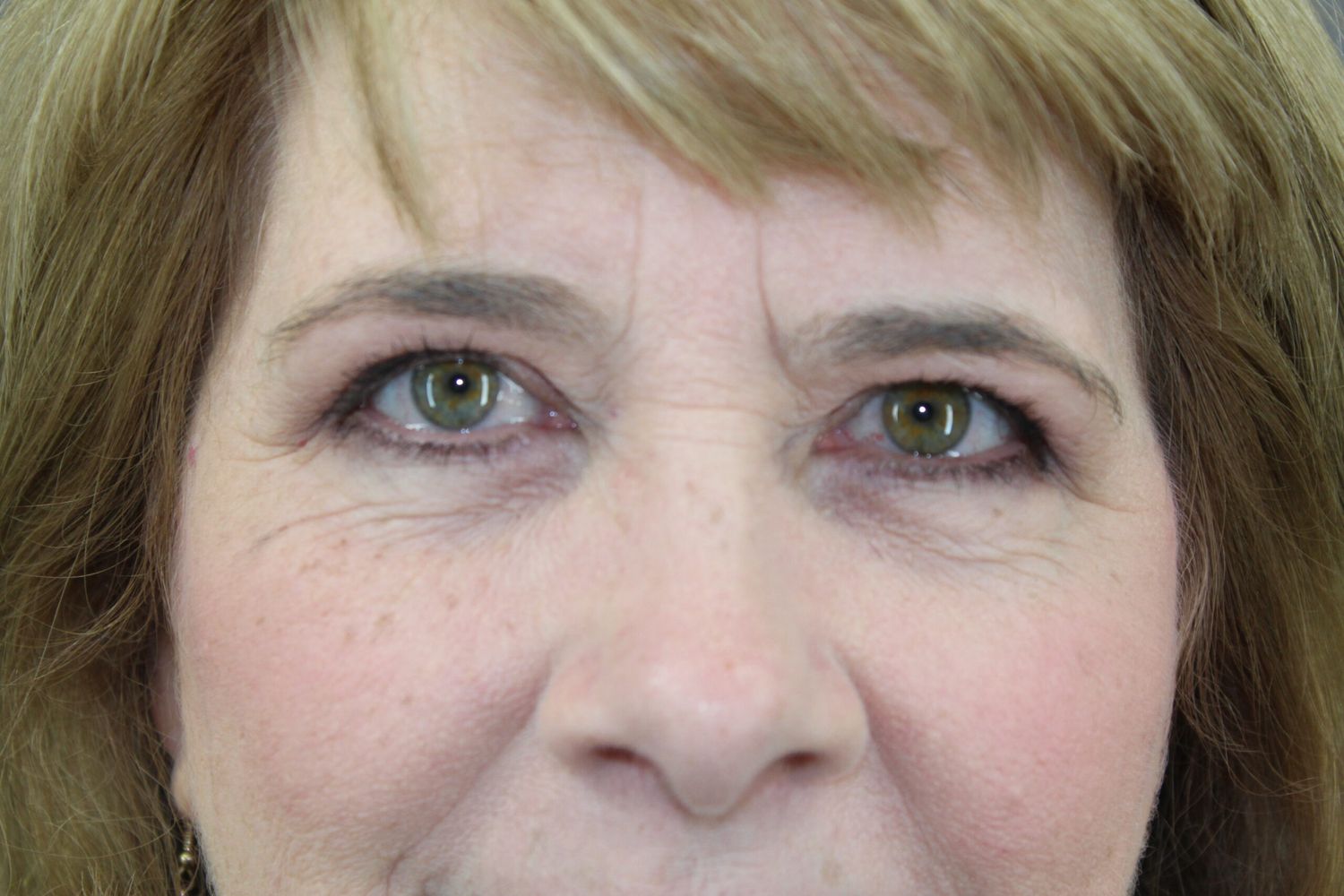 Brow Lift Before & After