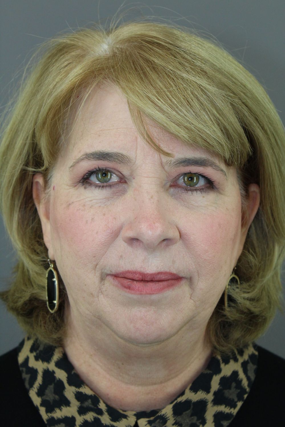 Brow Lift Before & After