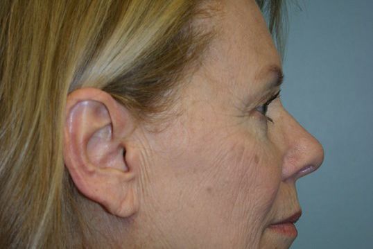 Brow Lift Before & After