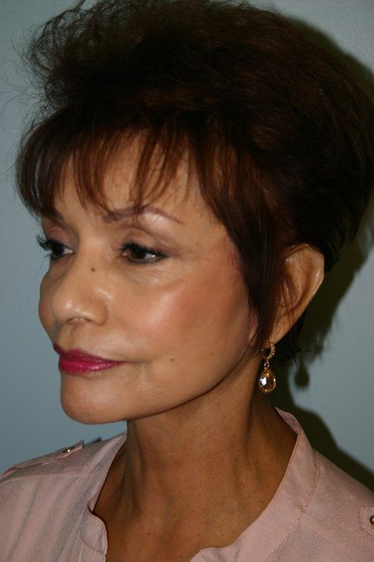 Brow Lift Before & After