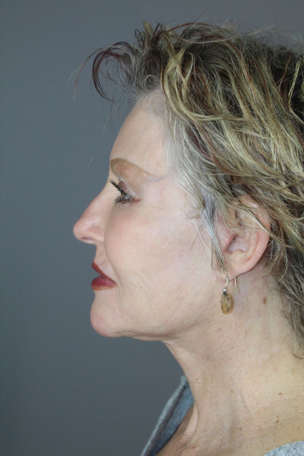 Zo Skin Health Before & After