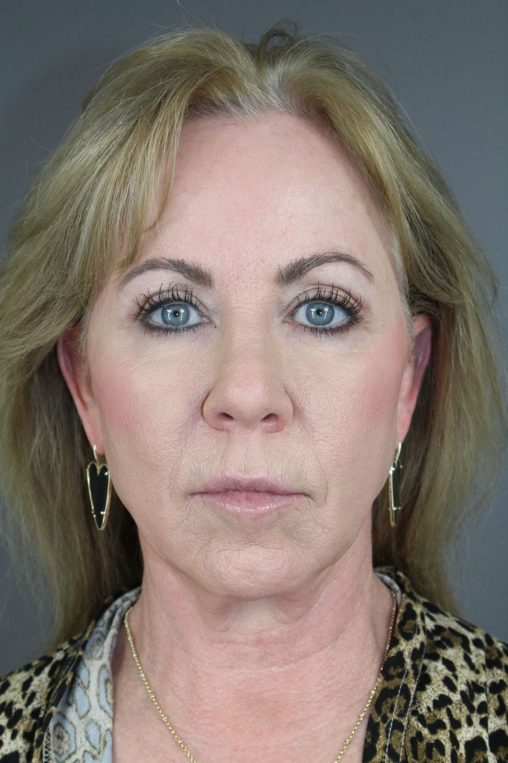 Zo Skin Health Before & After