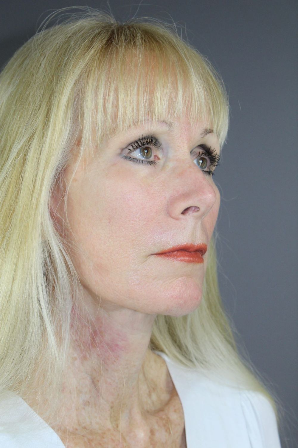 Zo Skin Health Before & After