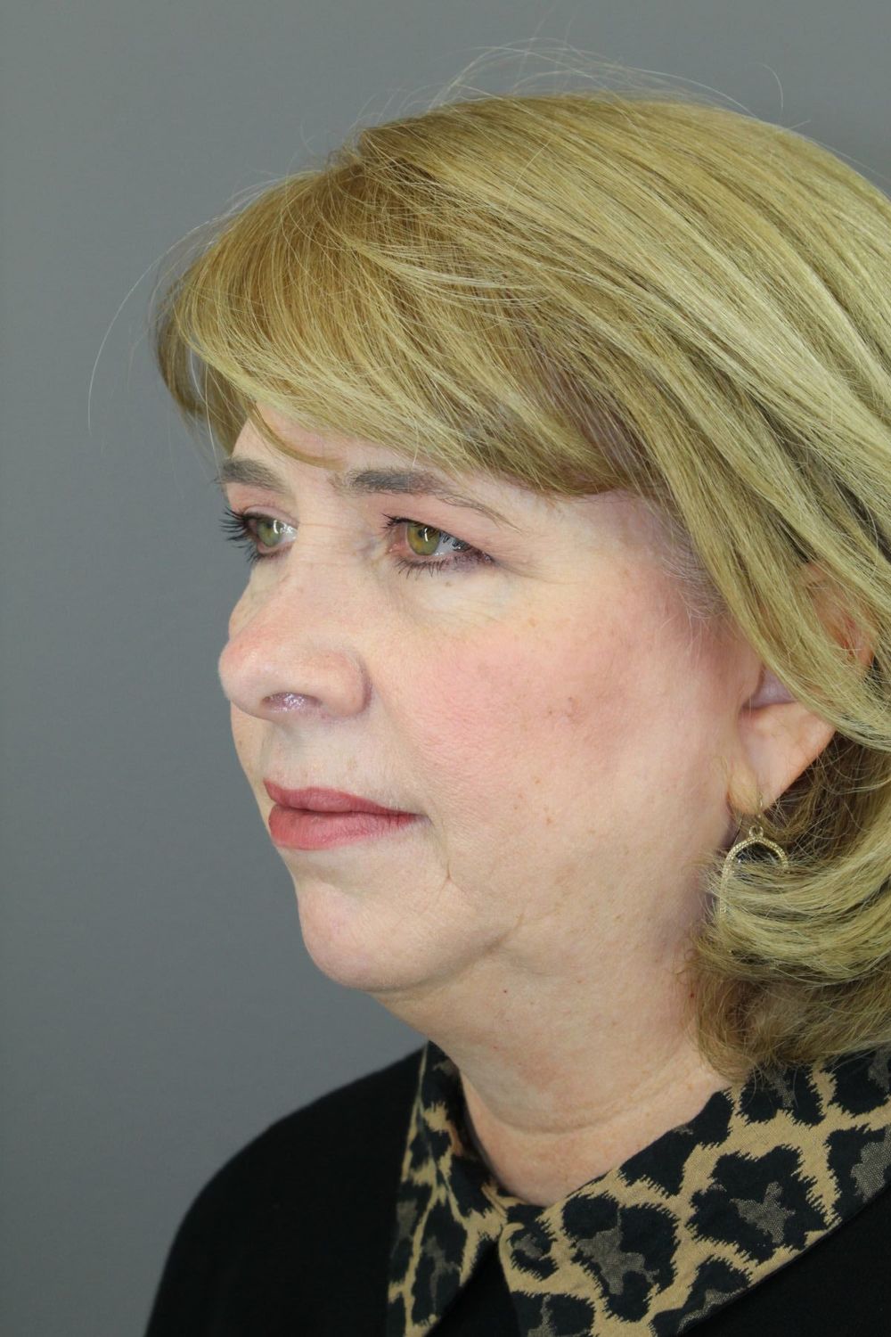 Zo Skin Health Before & After