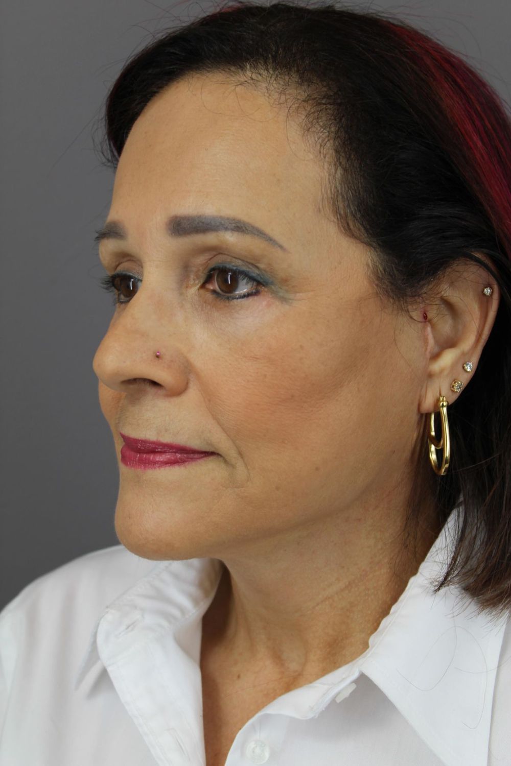 Zo Skin Health Before & After