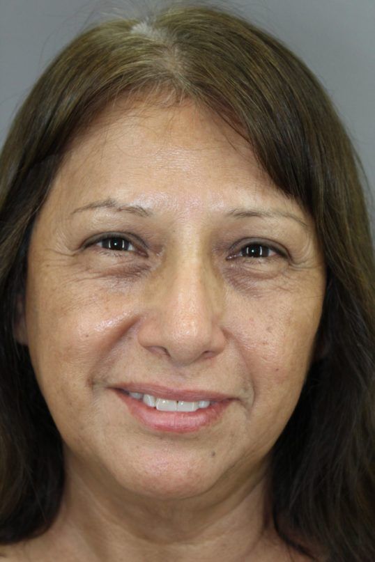 Zo Skin Health Before & After