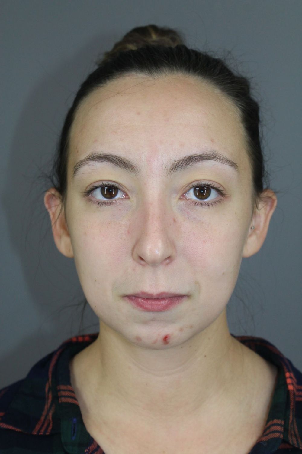 Chin Augmentation Before & After