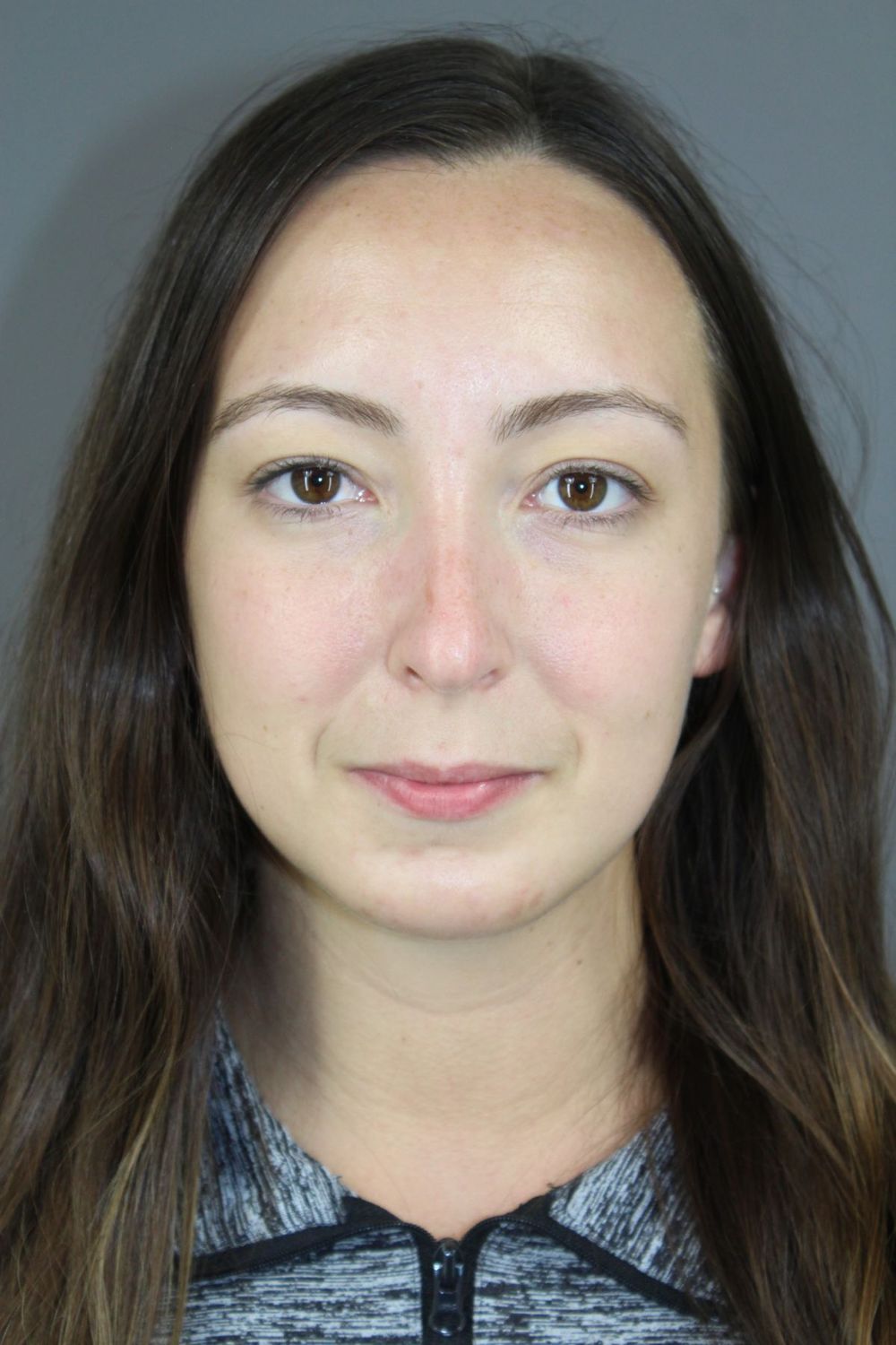 Chin Augmentation Before & After