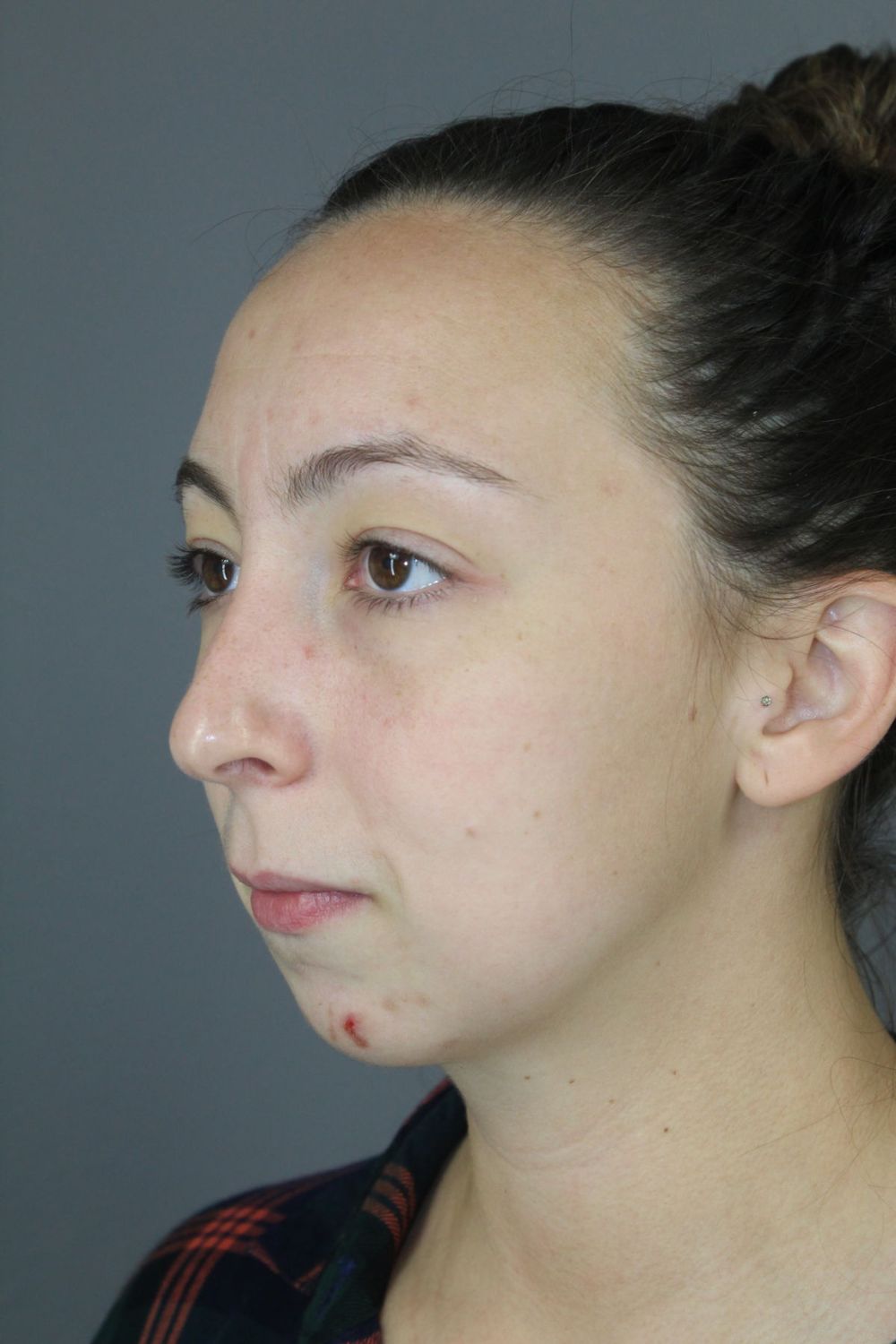 Chin Augmentation Before & After