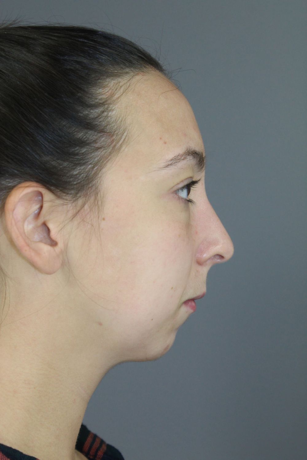 Chin Augmentation Before & After